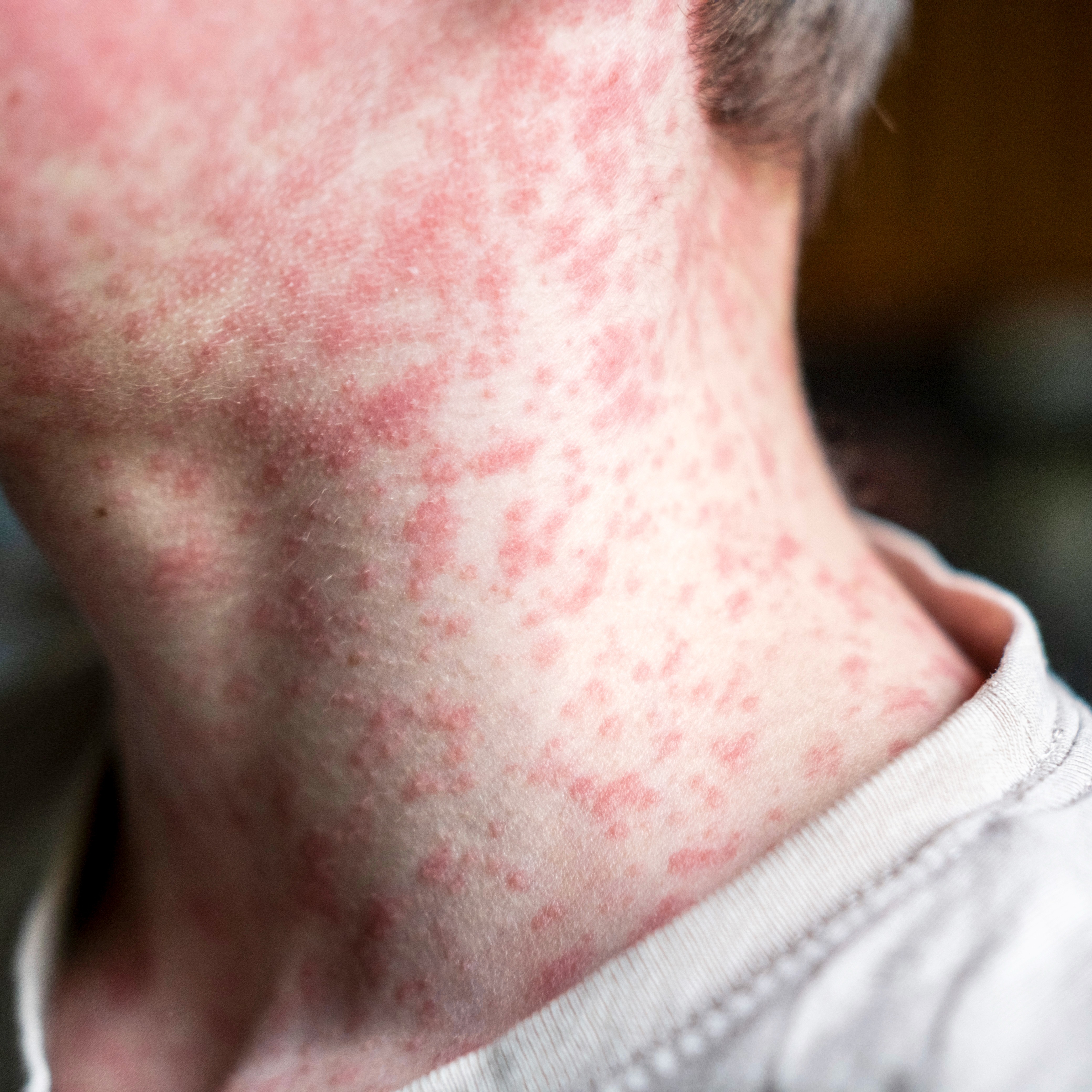 Oakland County confirms pediatric measles case episode artwork