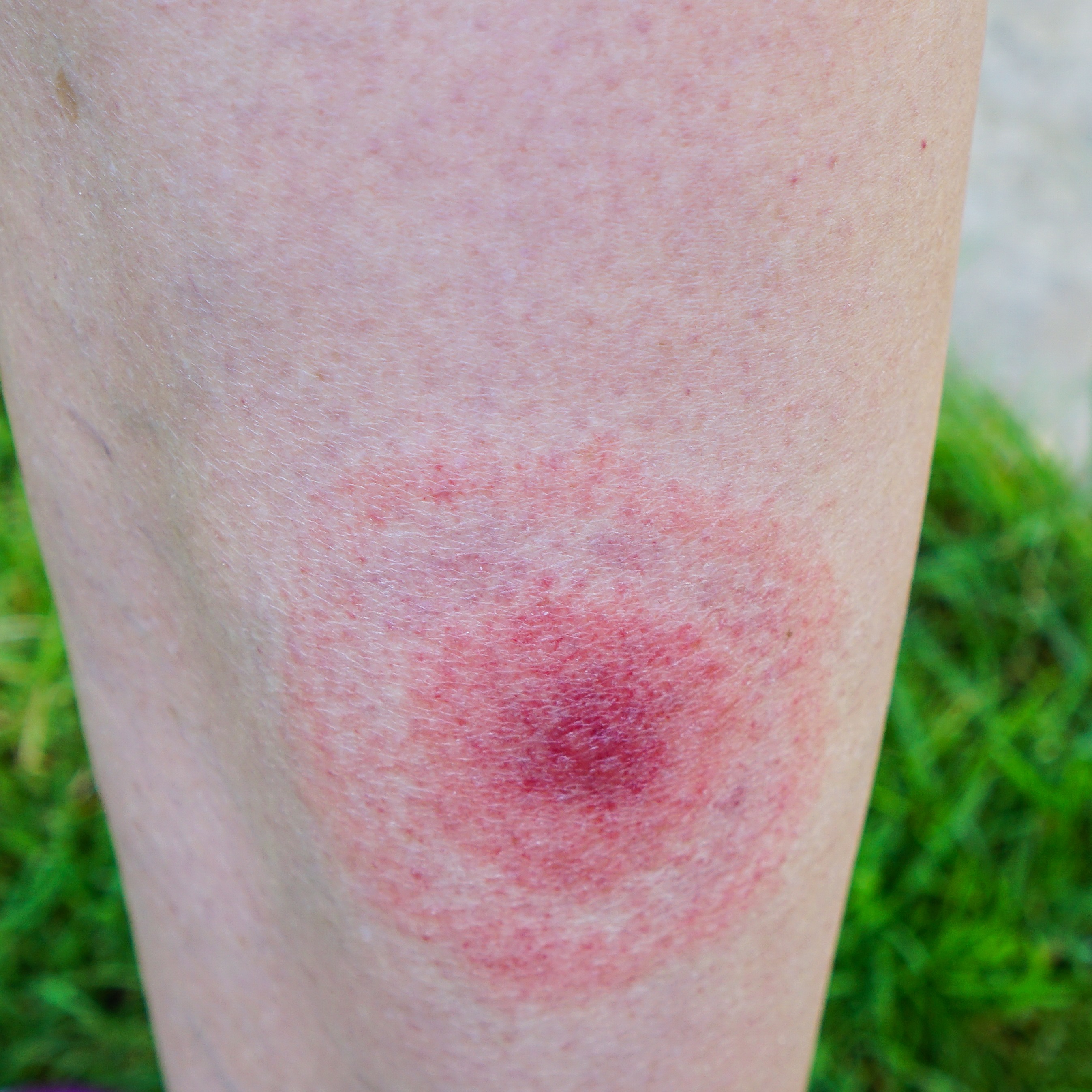 Local woman shares her journey with Lyme disease episode artwork