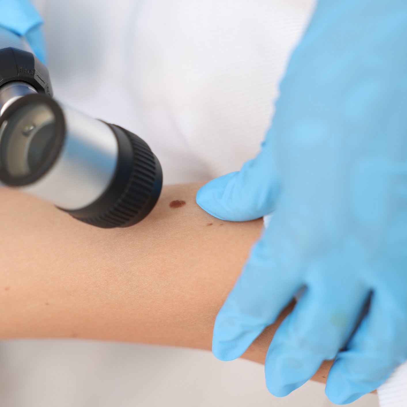Over 25% of melanomas go undetected until after they've spread episode artwork