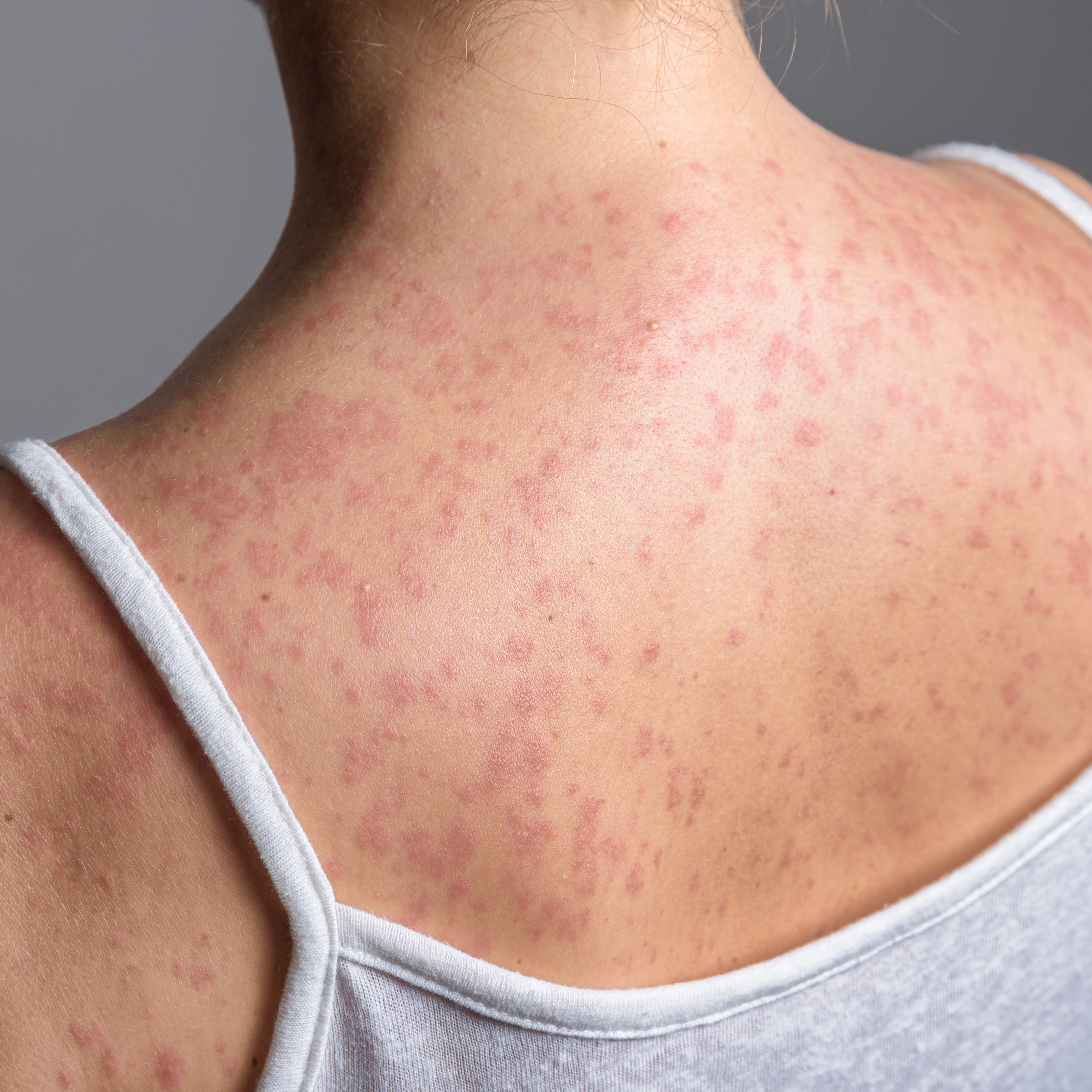 What can be done as measles cases continue to rise? episode artwork