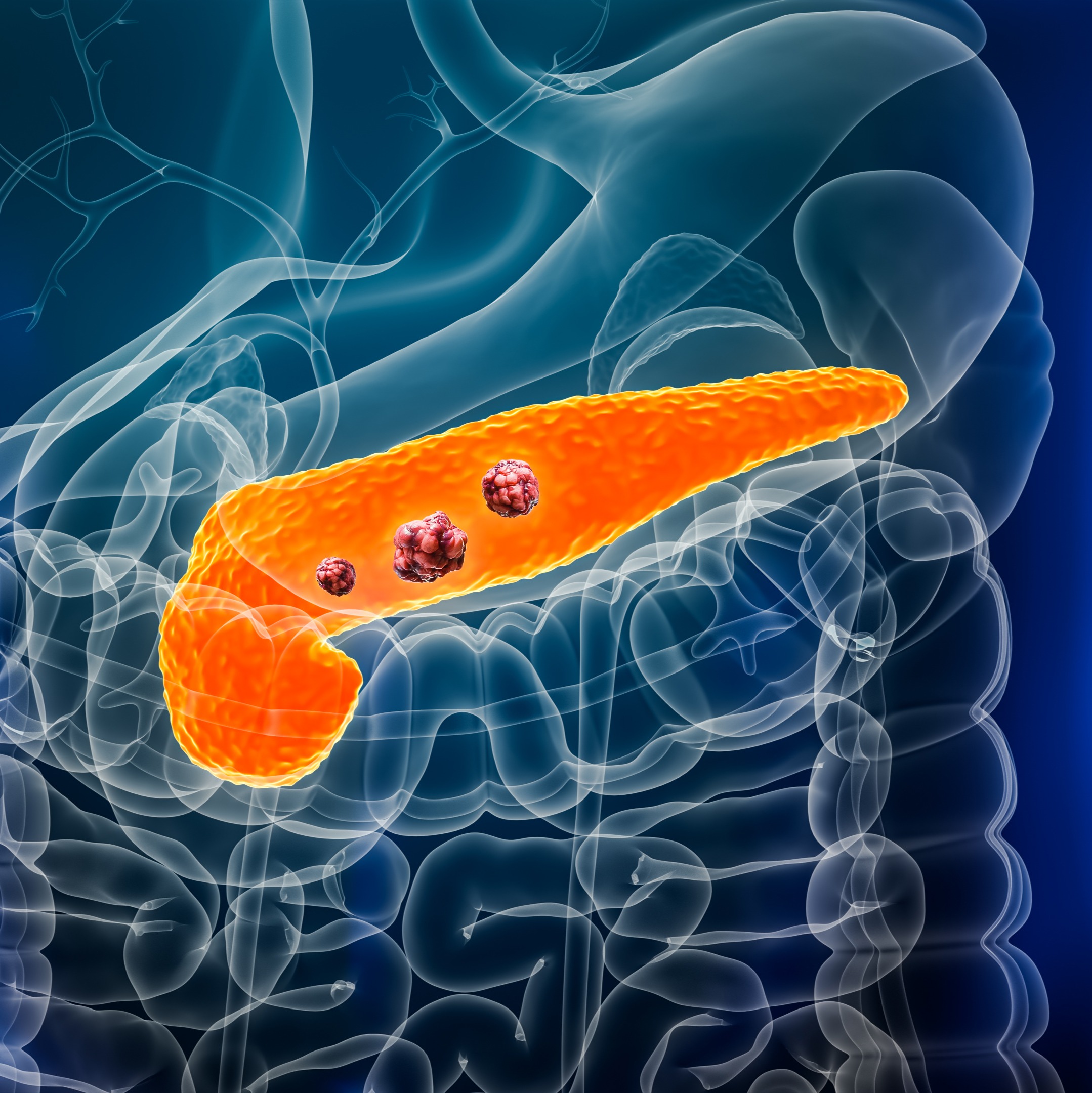 The reality of pancreatic cancer with Dr. Patrick Dreyer, MN Oncology episode artwork
