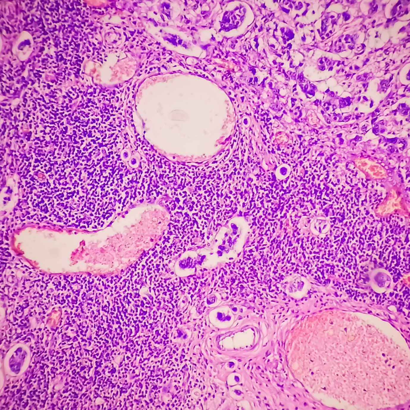 Breast cancer vaccine trial at Stony Brook has potential to be a major breakthrough episode artwork