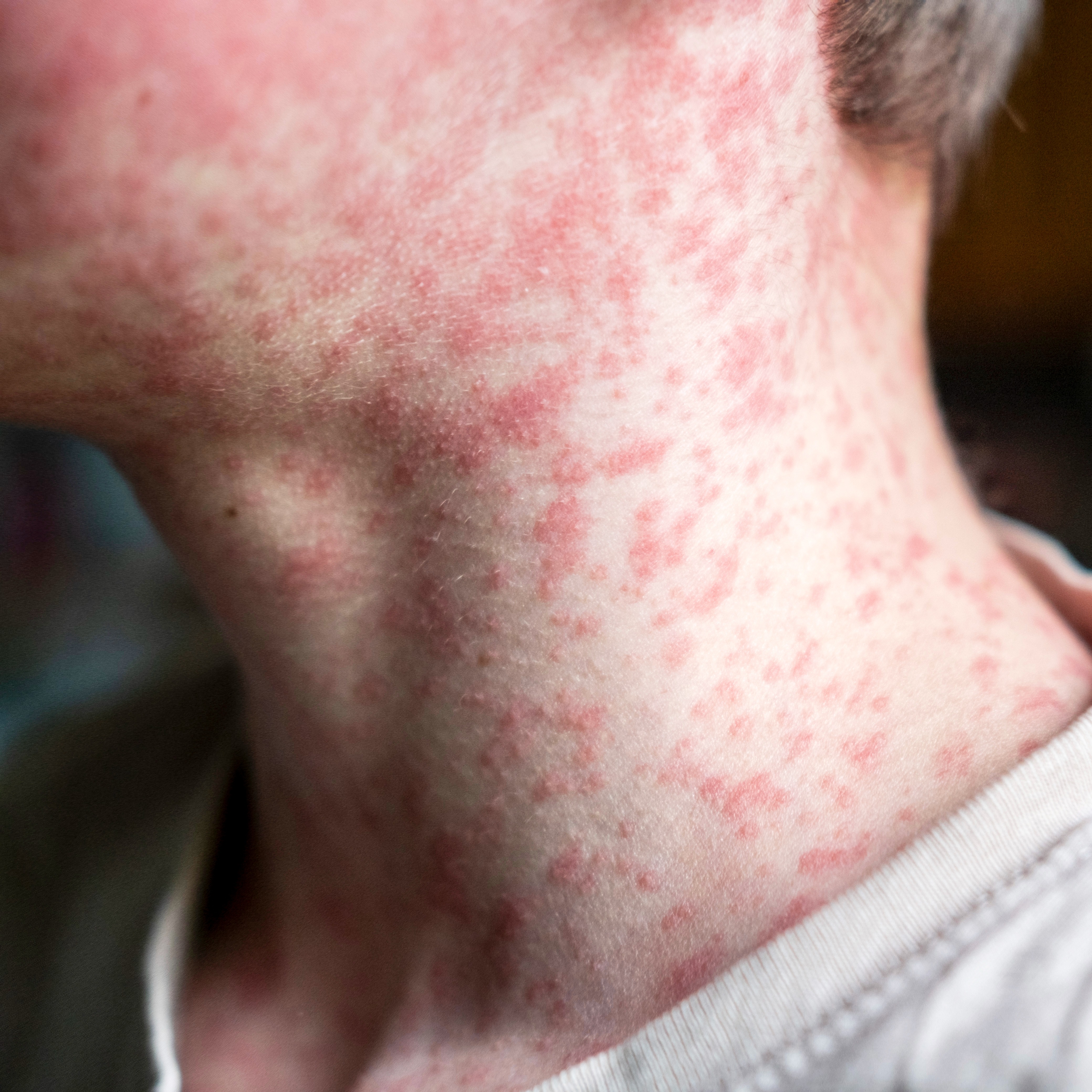 Measles cases in US surpass 2,000 for the second year in a row episode artwork