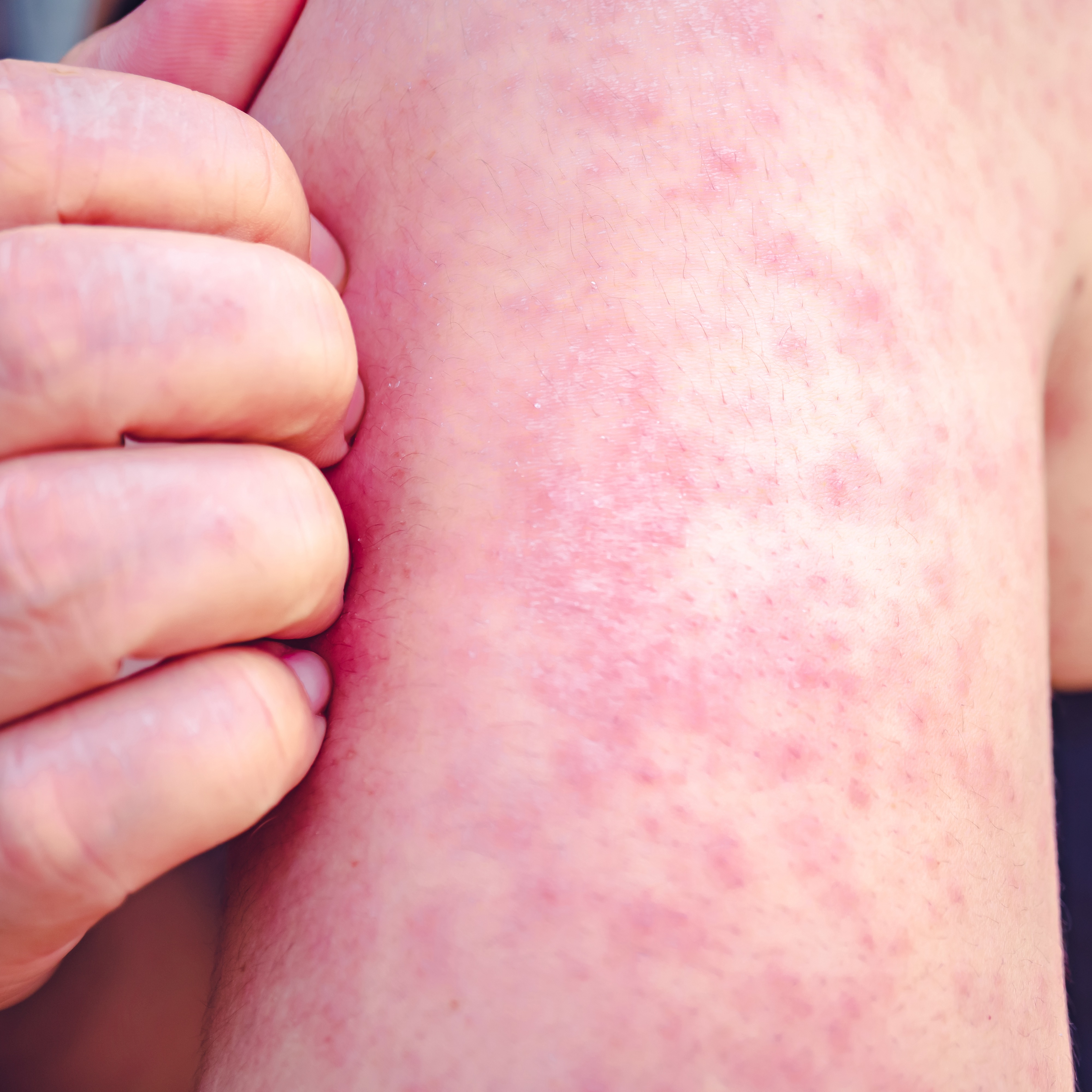 Delaware County officials urge caution, vaccination after measles is found in wastewater samples episode artwork