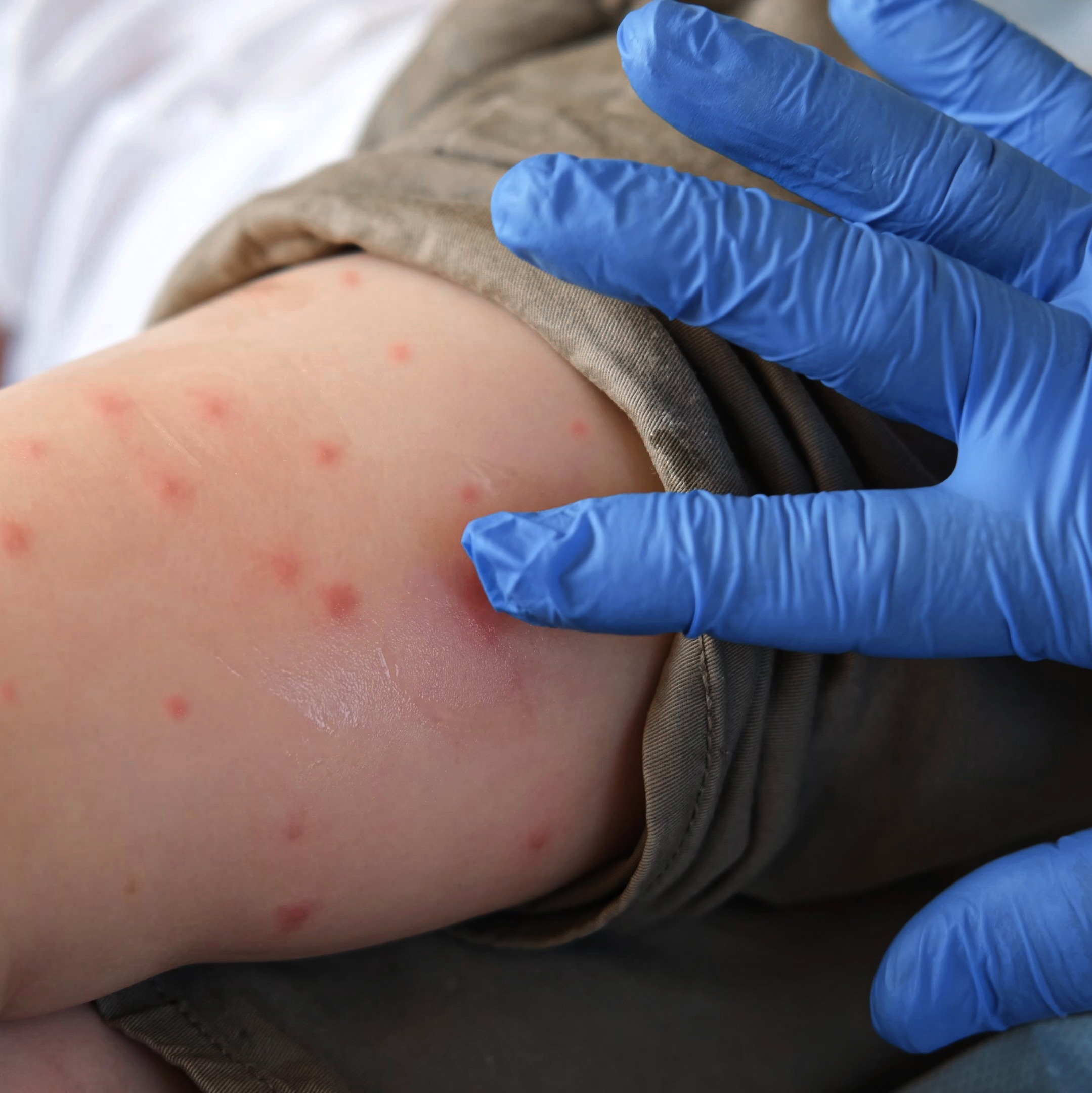 Health officials warn of possible measles exposure at PHL episode artwork