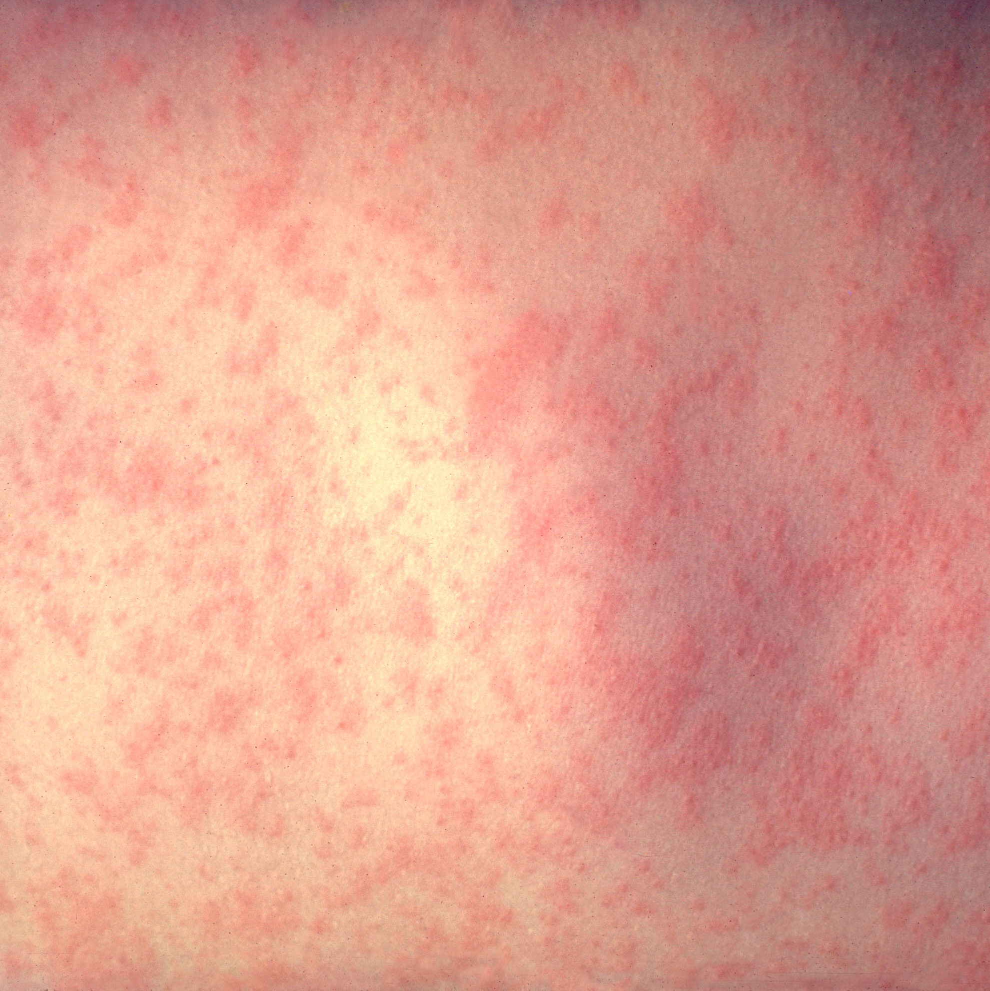 Delaware records first measles case in more than a decade episode artwork