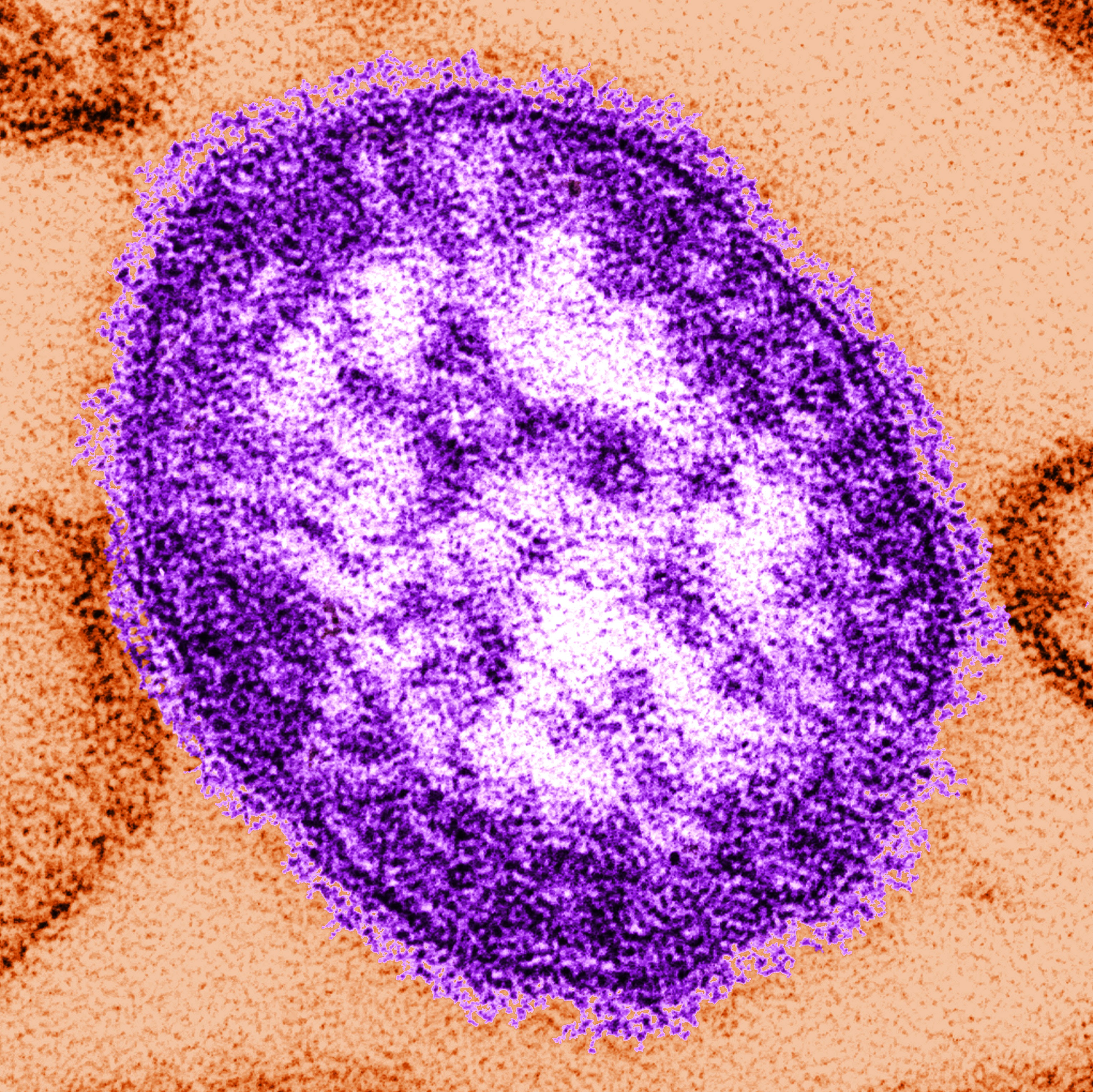 Pa. reports state’s 3rd measles-related death episode artwork