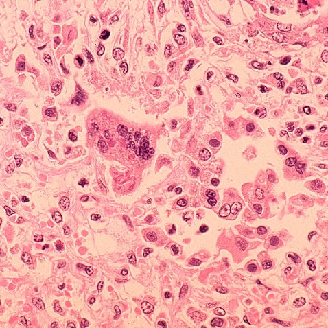2 additional measles deaths confirmed in Pennsylvania episode artwork