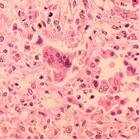 Pennsylvania surpasses 900 measles cases episode artwork