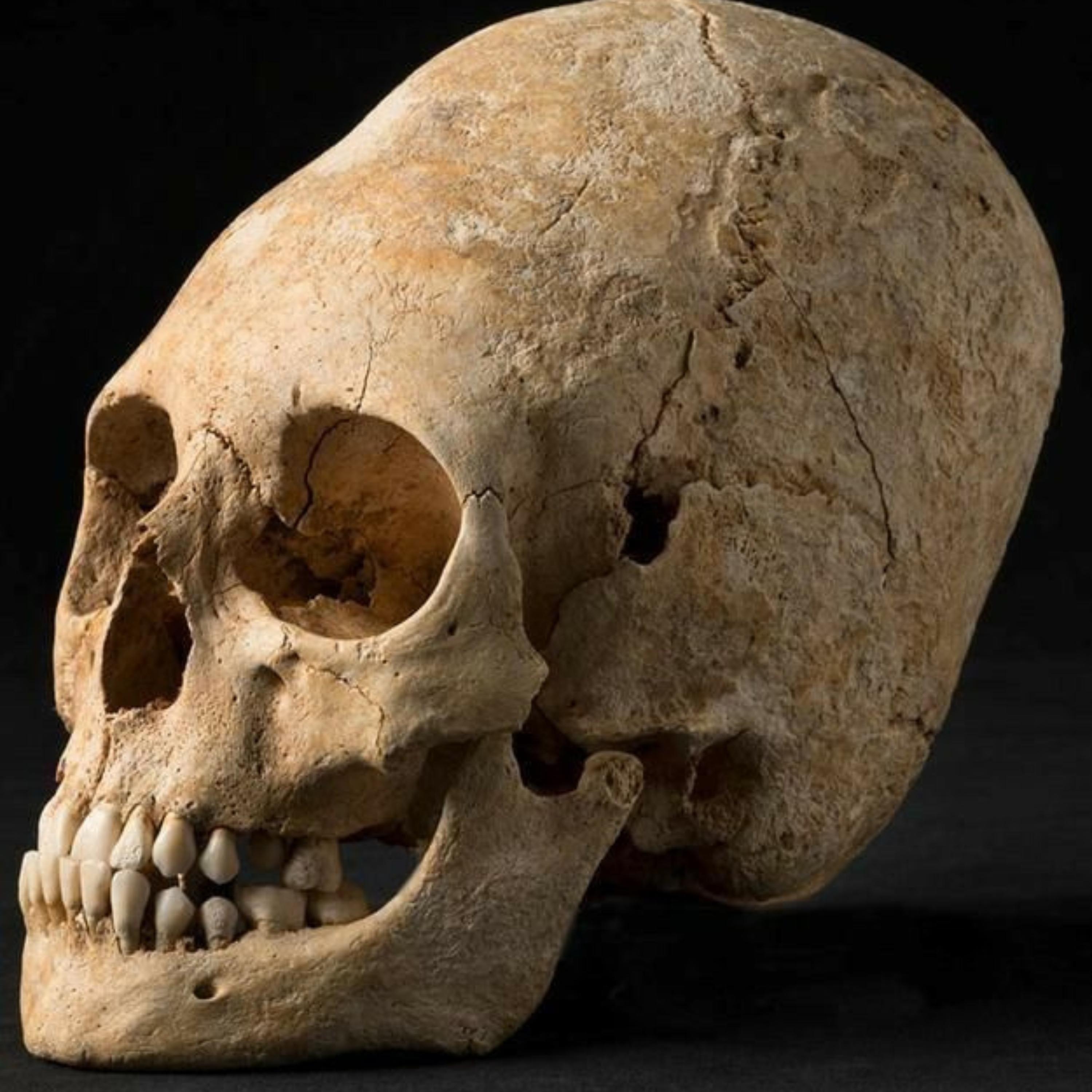 Elongated Skulls: Human or Alien Elongated Skulls: Human or Alien