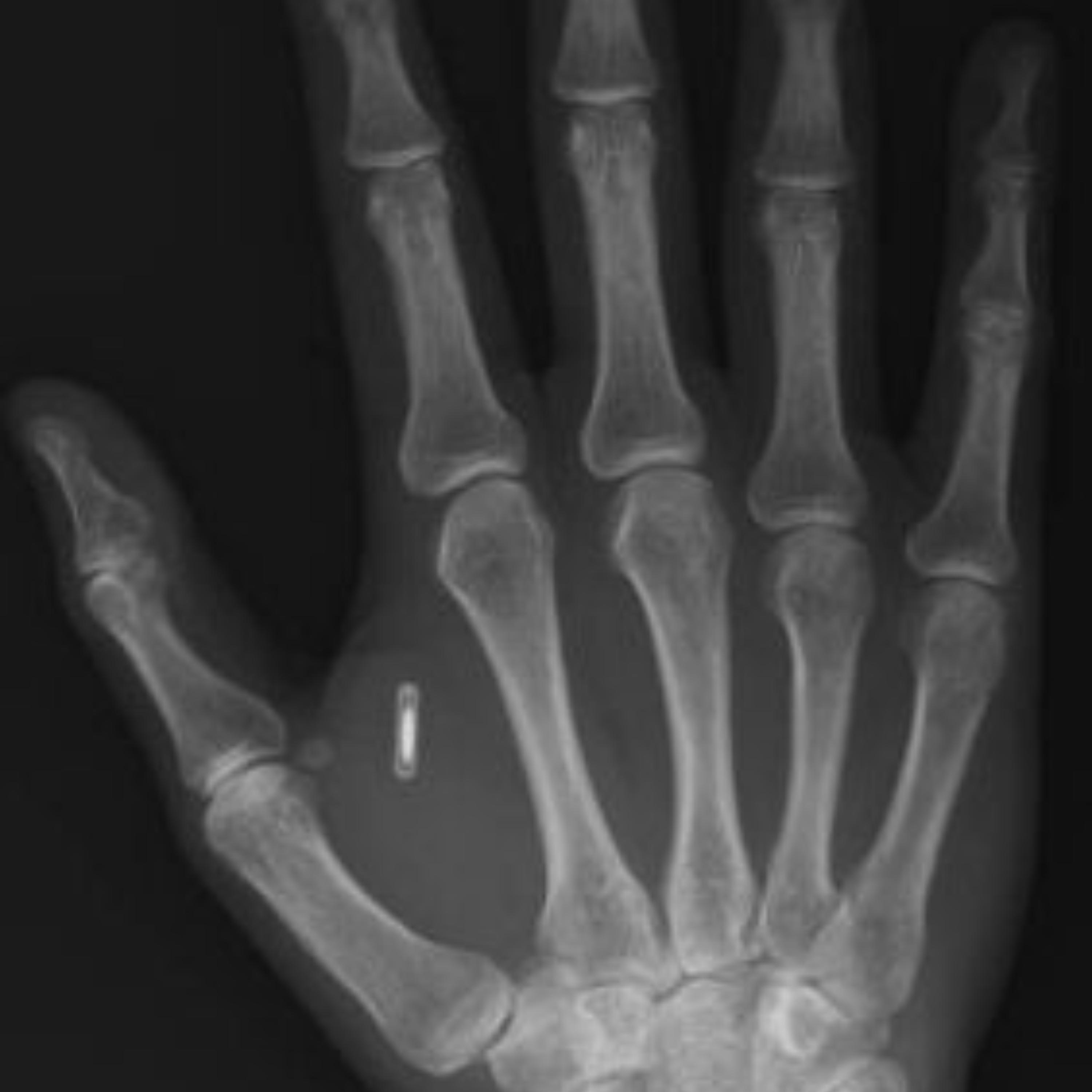 The Invisible Crime: Illegal Microchip Implants and Microwave Technology
